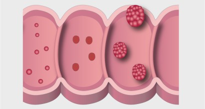 Mistakes in colorectal cancer and how to avoid them