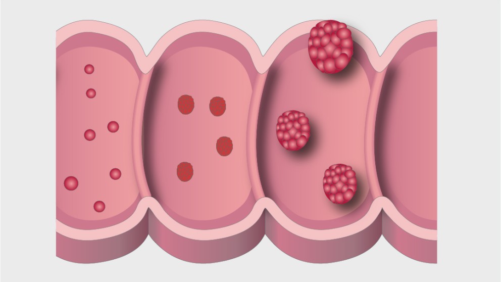 Mistakes in colorectal cancer and how to avoid them