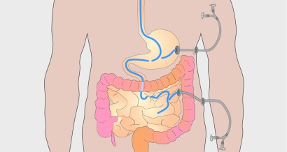 Mistakes in jejunal feeding and how to avoid them