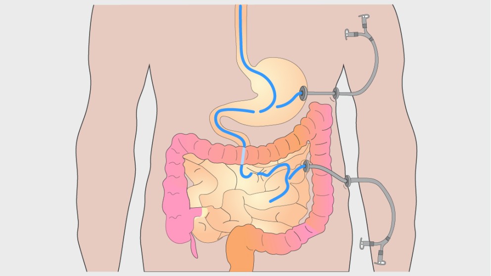 Mistakes in jejunal feeding and how to avoid them