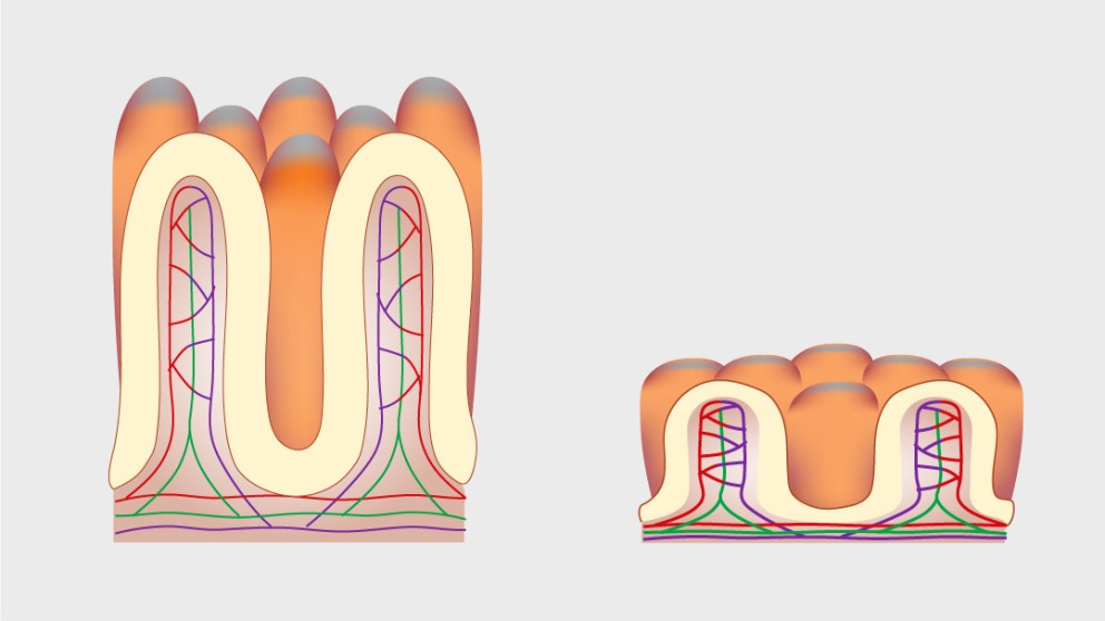 Mistakes in refractory coeliac disease and how to avoid them