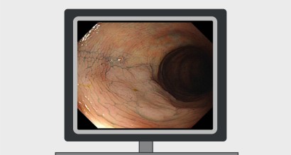 Mistakes in colonoscopic surveillance in IBD  and how to avoid them