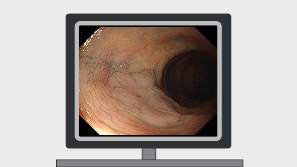 Mistakes in colonoscopic surveillance in IBD  and how to avoid them