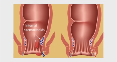 Mistakes in managing perianal disease and how to avoid them