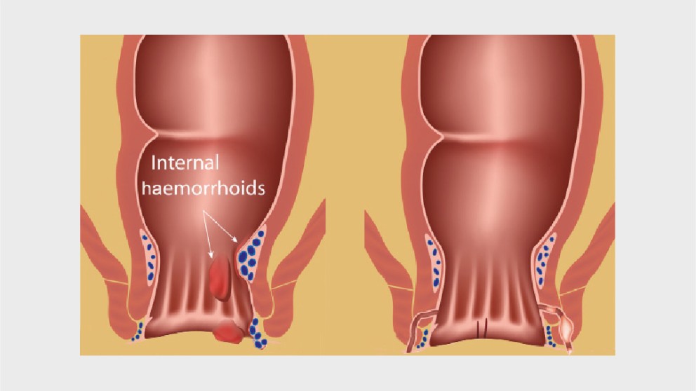 Mistakes in managing perianal disease and how to avoid them