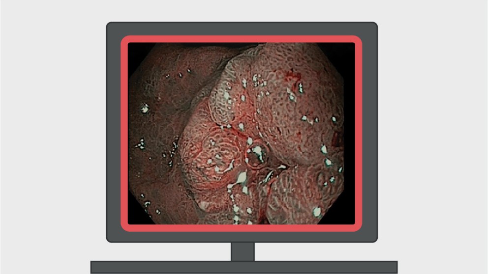 Mistakes in endoscopy and how to avoid them