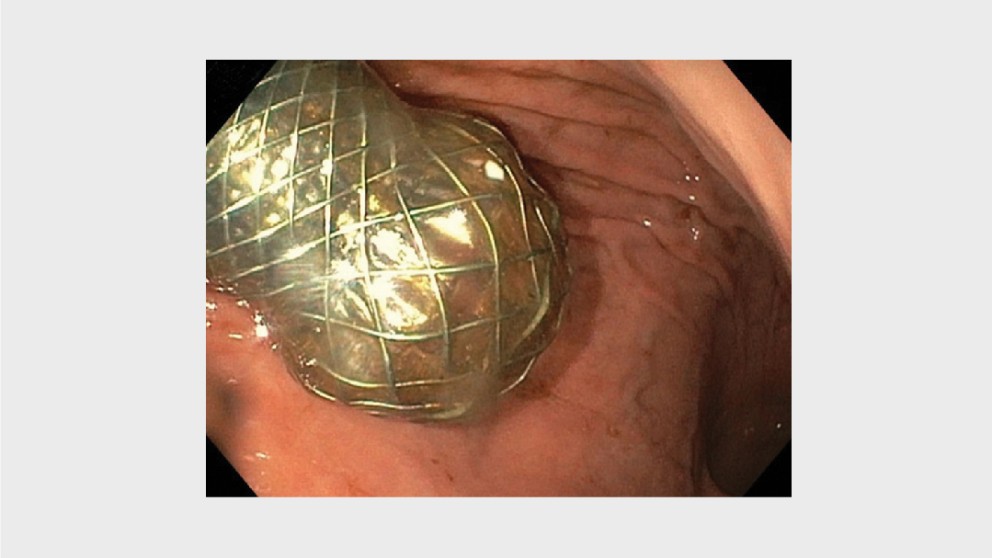 Mistakes in enteral stenting and how to avoid them