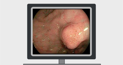 Mistakes in the management of gastric polyps and how to avoid them