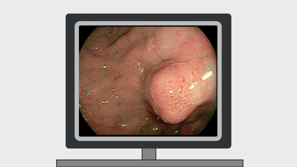 Mistakes in the management of gastric polyps and how to avoid them