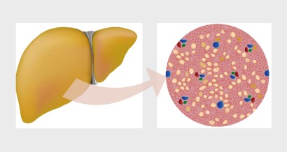 Mistakes in nonalcoholic fatty liver disease and how to avoid them