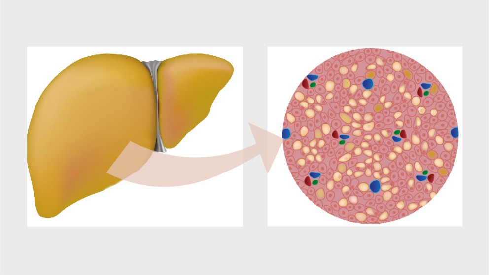 Mistakes in metabolic dysfunction associated steatotic liver disease and how to avoid them