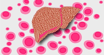 Mistakes in coagulation in liver disease and how to avoid them