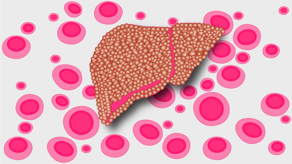 Mistakes in coagulation in liver disease and how to avoid them
