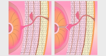 Mistakes in the management of enterocutaneous fistulae and how to avoid them