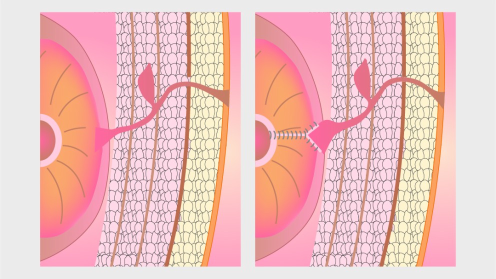 Mistakes in the management of enterocutaneous fistulae and how to avoid them