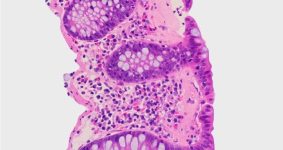 Mistakes in microscopic colitis and how to avoid them