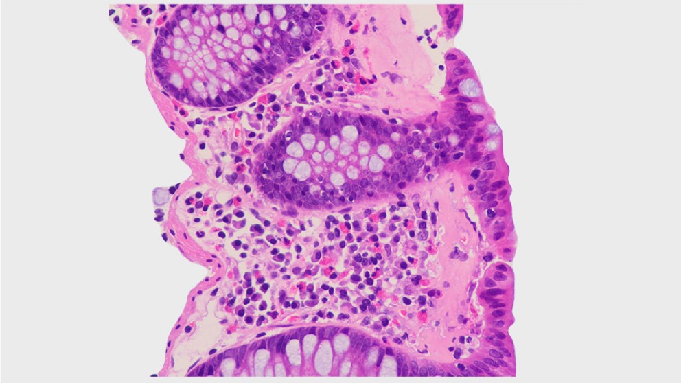 Mistakes in microscopic colitis and how to avoid them