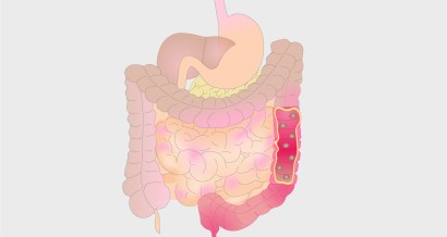 Ulcerative colitis