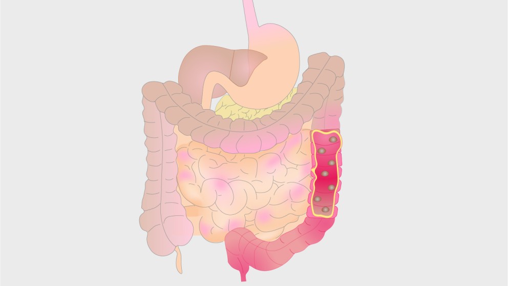 Ulcerative colitis