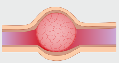 Subepithelial Lesions in the  Upper Gastrointestinal Tract