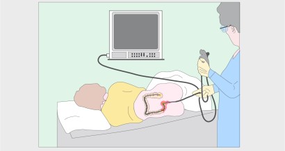 Mistakes in malignancy surveillance in IBD and how to avoid them