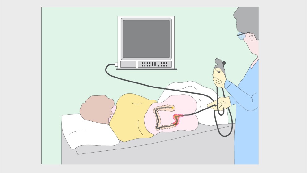 Mistakes in malignancy surveillance in IBD and how to avoid them