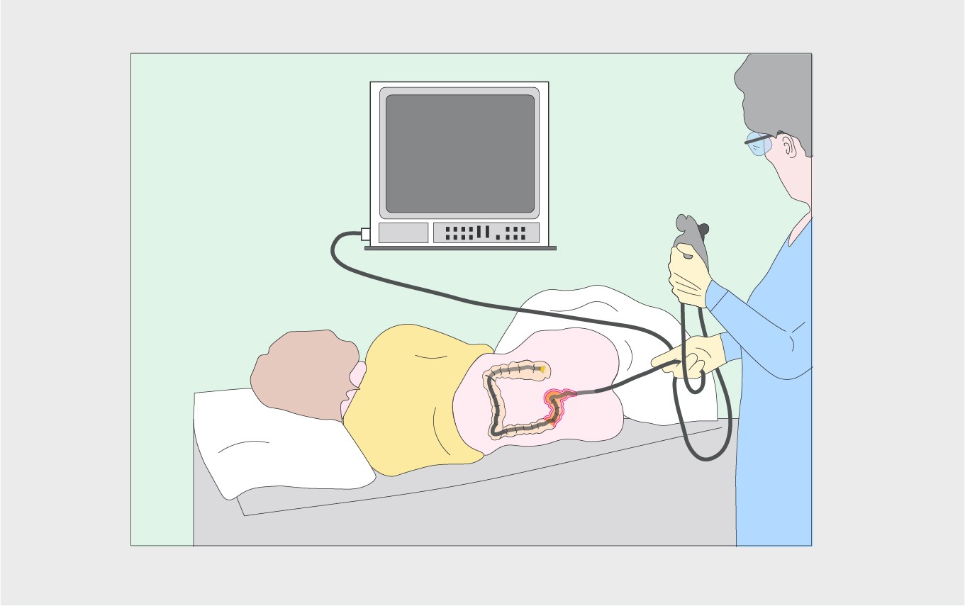 Mistakes in Malignancy surveillance in IBD and how to avoid them