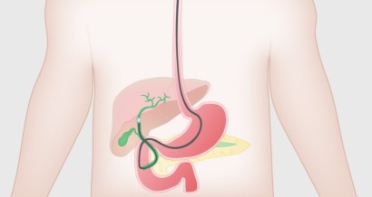 Mistakes in cholangioscopy and how to avoid them