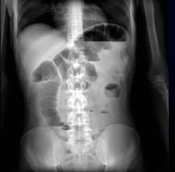 Figure 1 | Anteroposterior plain radiograph of the abdomen, acquired in standing position, showing air distention of several small bowel loops, associated with the presence of levels suggesting bowel obstruction.