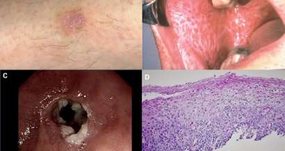 A case at the crossroads of dermatology and gastroenterology