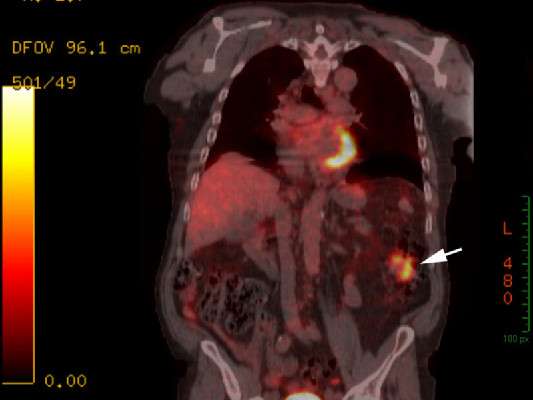 The hot PET | UEG - United European Gastroenterology