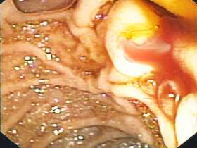 Figure 1a-c | The endoscopic appearance of the duodenal ampulla.