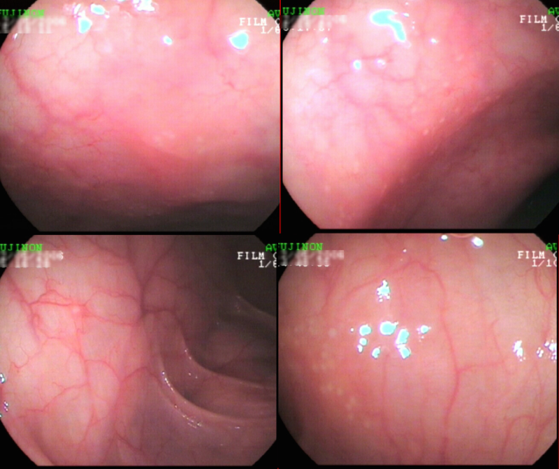 A curious case of colitis