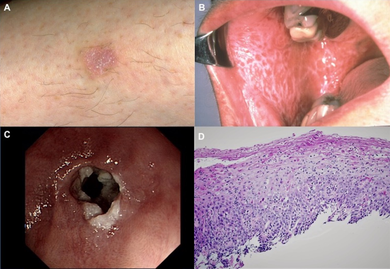 A case at the crossroads of dermatology and gastroenterology