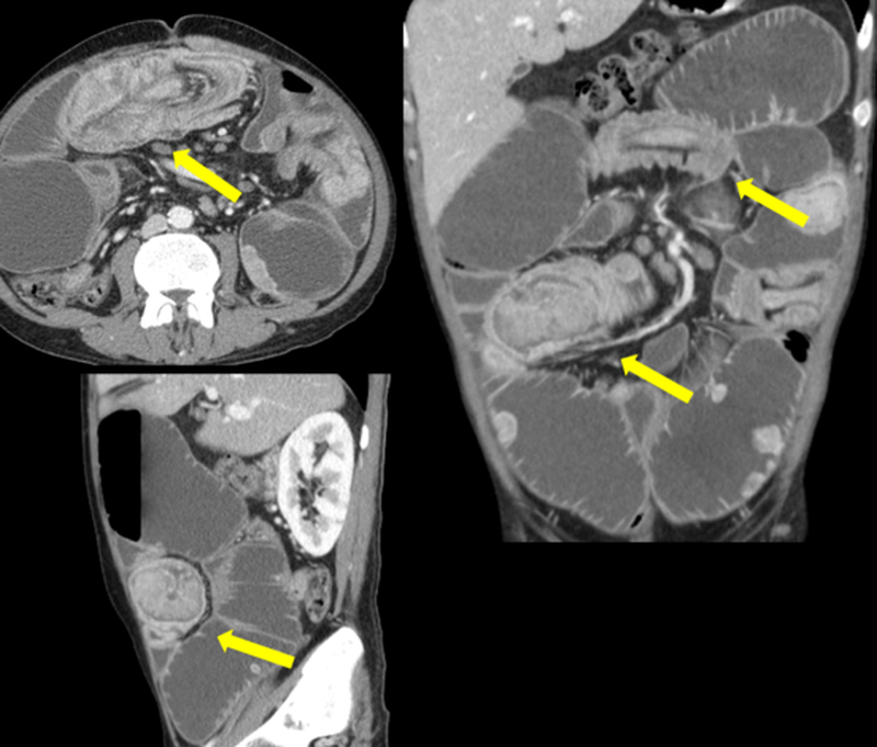 Figure 3 | Small bowel intussusceptions involving different segments of ileal loops are highlighted by the yellow arrows on the multiplanar abdominal contrast-enhanced CT images shown in figure 2.