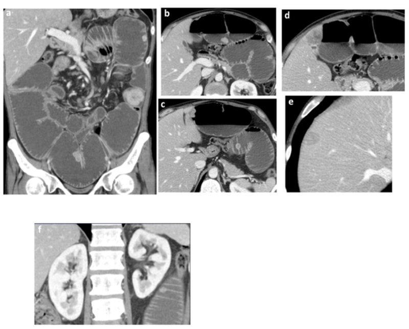 Figure 4 | Second-look of abdominal contrast-enhanced CT scan with coronal and sagittal reconstructions; images were acquired at portal venous time (about 70 seconds after injection of iodinated contrast medium).