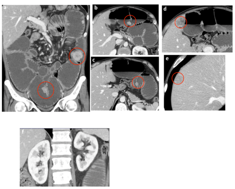Figure 5 | A more accurate evaluation of the images in figure 4 allows the identification of multiple enhancing nodules distributed along the walls of the small bowel, as well of several enlarged lymph nodes within the mesenteric fat (a,b,c). Parenchymal 