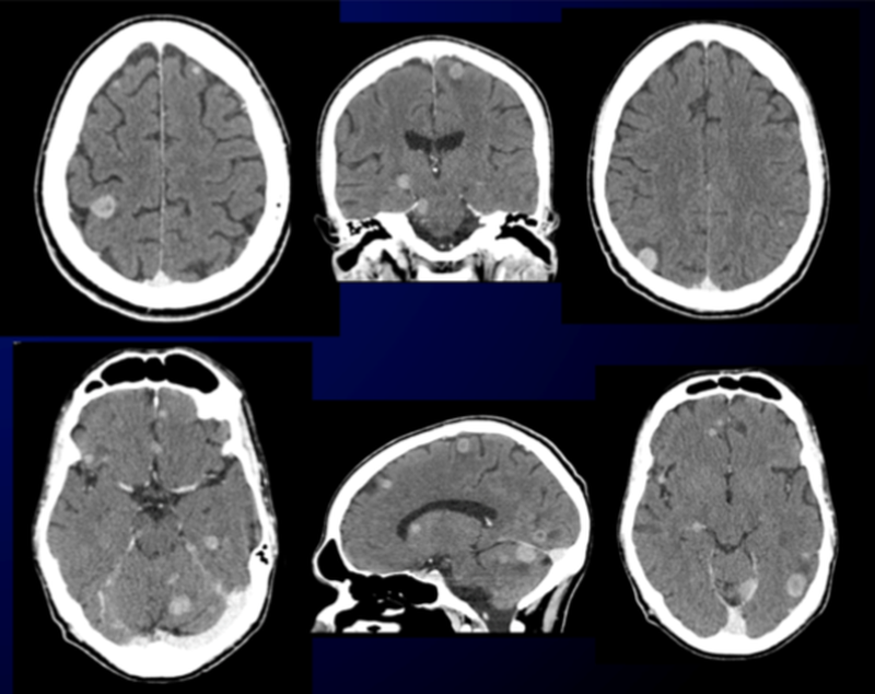 Figure 6 | Unenhanced head CT showing the presence of multiple nodules, involving both cerebral and cerebellar parenchyma, consistent with cerebral metastases.