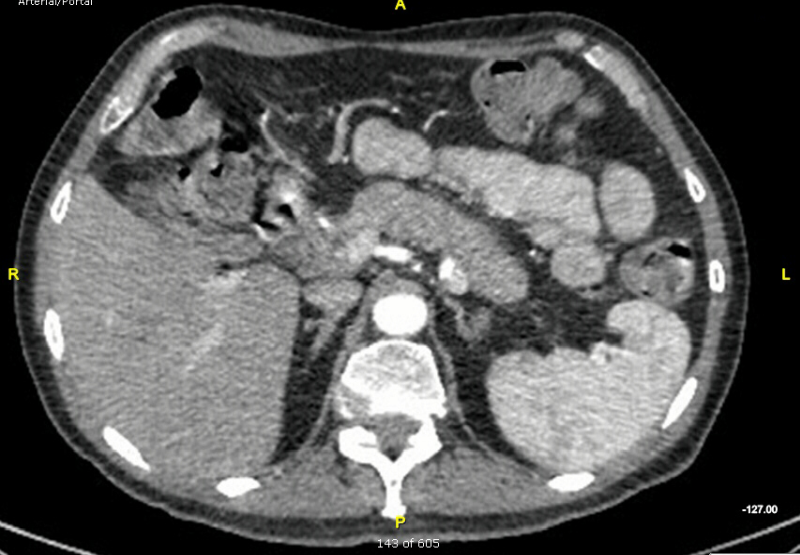 Figure 1 | Abdominal CT scan of a 65-year-old man with obstructive jaundice.