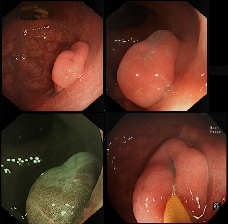 Figure 1 | The nodule found in the rectum of the case patient.