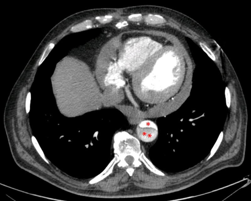 Figure 2 | Contrast CT scan showing dissection of the thoracic aorta. The true lumen (*) and false lumen (**) can be clearly distinguished.Image courtesy of D Ligresti.