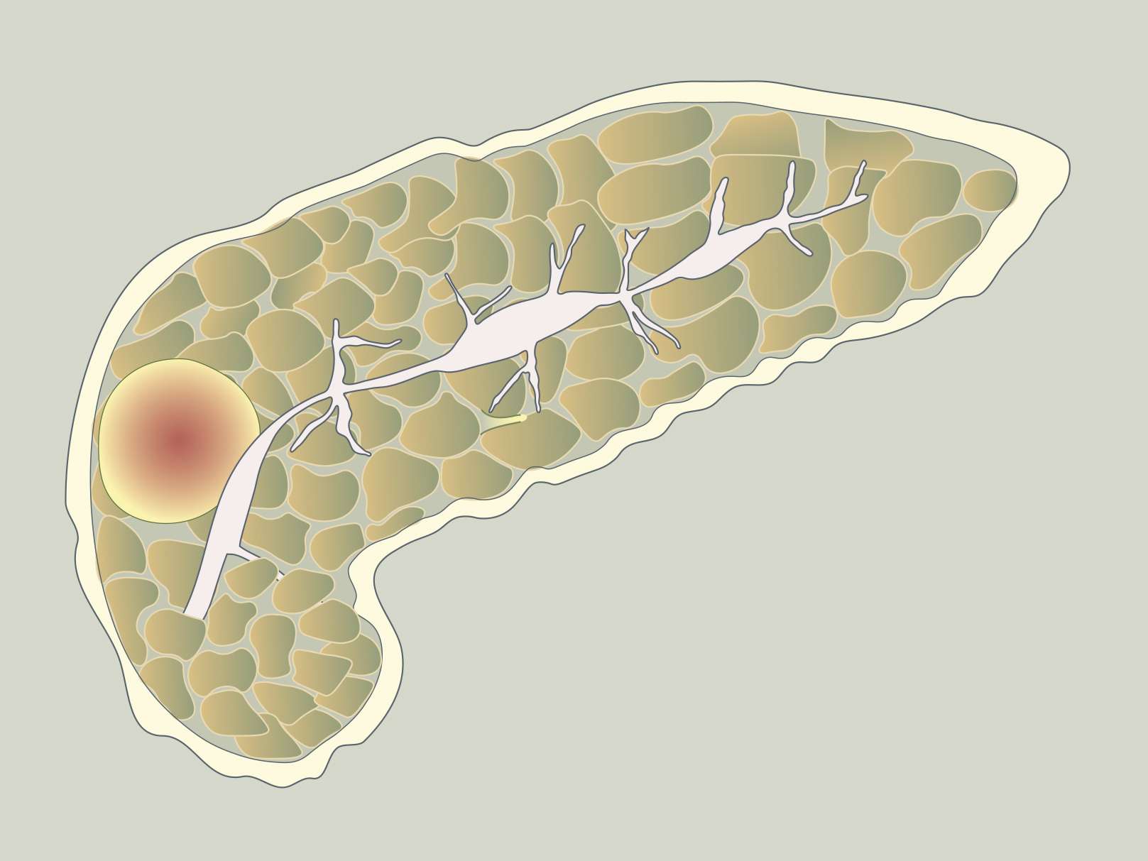 Pankreatitis autoimun: gejala dan rawatan