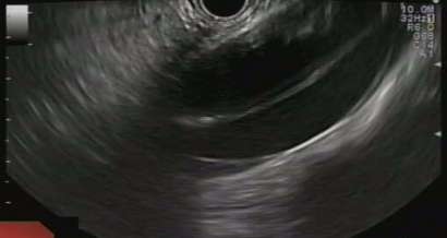 An incidental diagnosis by endoscopic ultrasound