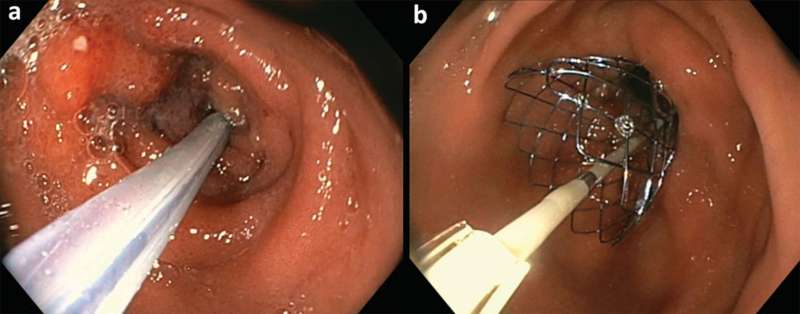 Duodenal stent placement.