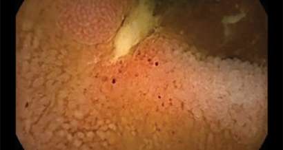 Mistakes in capsule endoscopy and how to avoid them