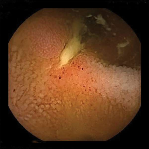 Mistakes in capsule endoscopy and how to avoid them