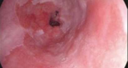 Mistakes in the endoscopic diagnosis and management of Barrett’s oesophagus and how to avoid them