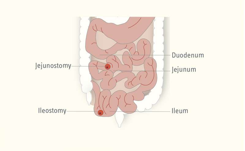 Mistakes in short bowel and how to avoid them