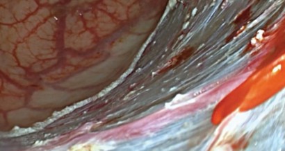 Mistakes in endoscopic resection and how to avoid them