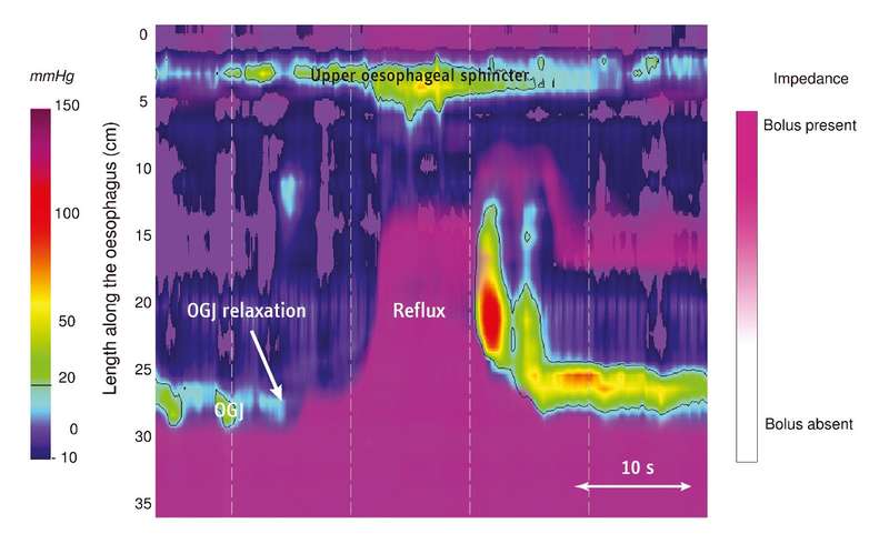 Mistakes In Gastro Oesophageal Reflux Disease Diagnosis And How To Avoid Them Ueg United 1511